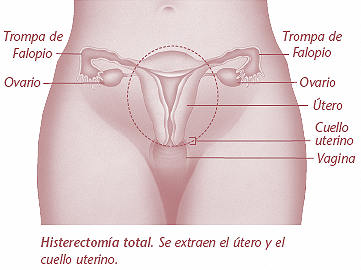 Histerectomia total Dr Benjamin Gloria Ginecologo Puebla