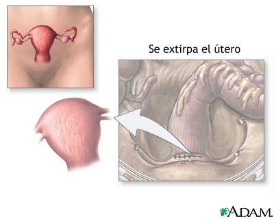 Histerectomia Dr Benjamin Gloria Ginecologo Puebla
